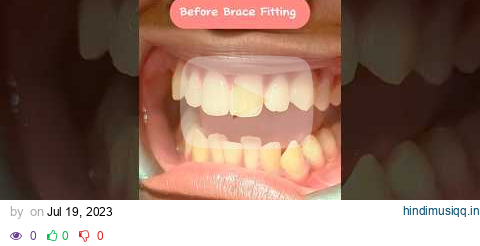 Before & After Brace Fitting Appointment! #shorts #braces pagalworld mp3 song download