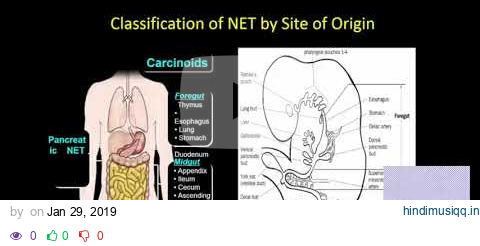 Current Management of Neuroendocrine Tumors at Mount Sinai pagalworld mp3 song download