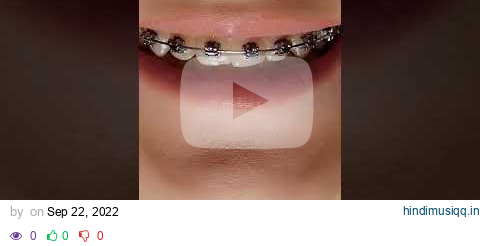 Preparing For Braces | Tip #3 pagalworld mp3 song download