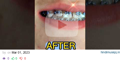 Before & After Brace Fitting Appointment. Spaced Teeth #shorts #braces pagalworld mp3 song download