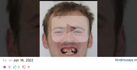 Before and after braces with @brace.book #shorts pagalworld mp3 song download