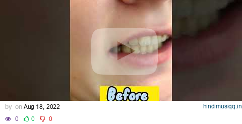 Retainers After Braces Fitting Appointment - Before & After #shorts #braces #retainers pagalworld mp3 song download