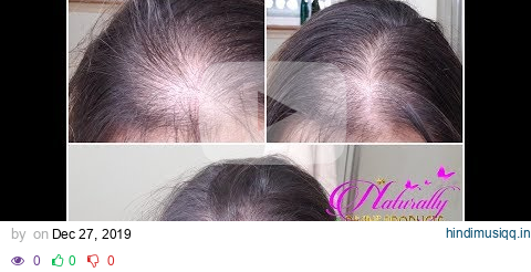 Reverse Hair Loss & Alopecia Fast pagalworld mp3 song download