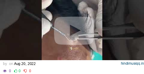 Mole on forehead Removal by RF | Painless mole removing #mole #remove #moles #awishclinic #shorts pagalworld mp3 song download