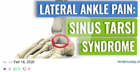 Sinus Tarsi Syndrome - One Cause of Lateral Ankle Pain pagalworld mp3 song download